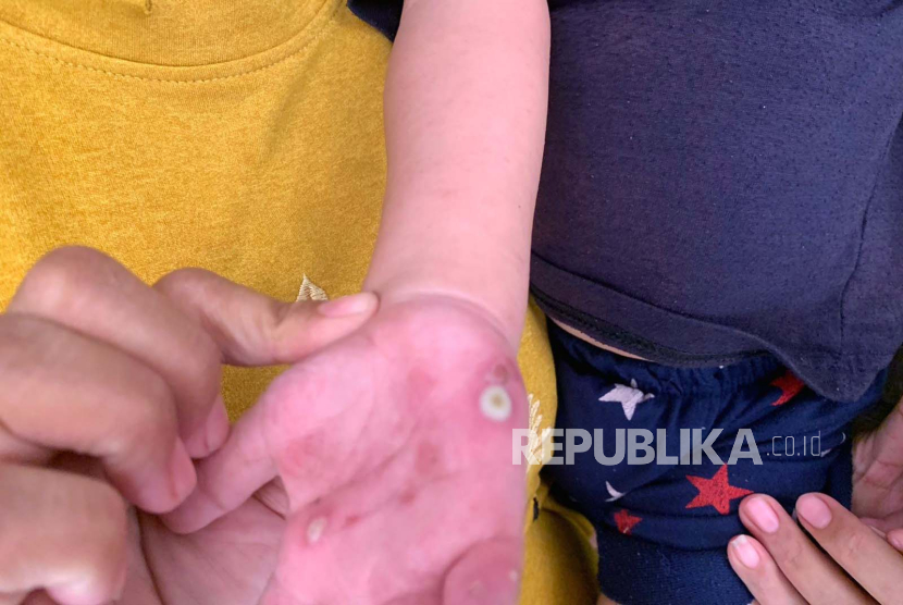 Puluhan warga Rusunawa Marunda, Jakarta Utara, Selasa (15/8/2023), mengalami sakit kulit dan gatal-gatal diduga imbas dari polusi udara dan debu batubara.