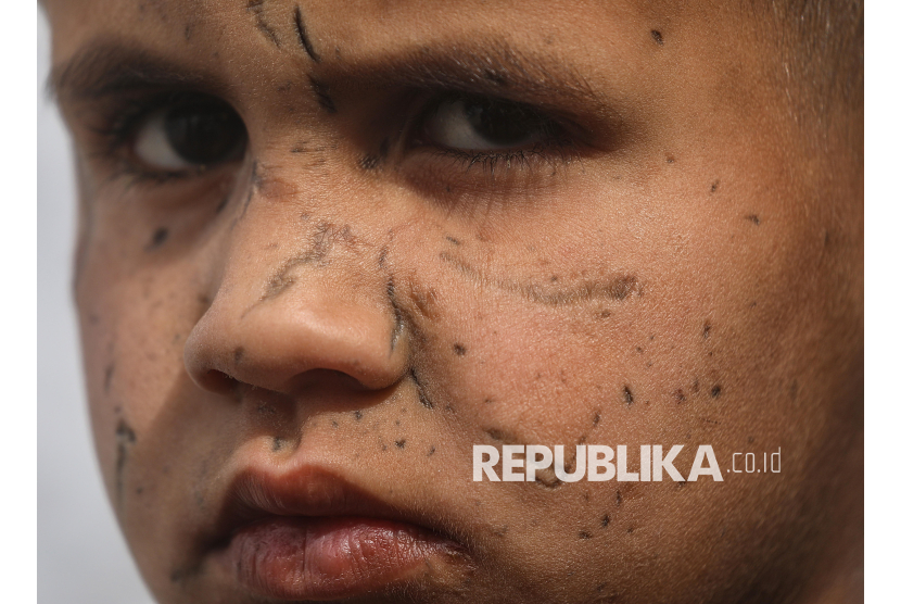 Bocah Palestina Kehilangan Penglihatan Akibat Serangan Israel di Gaza