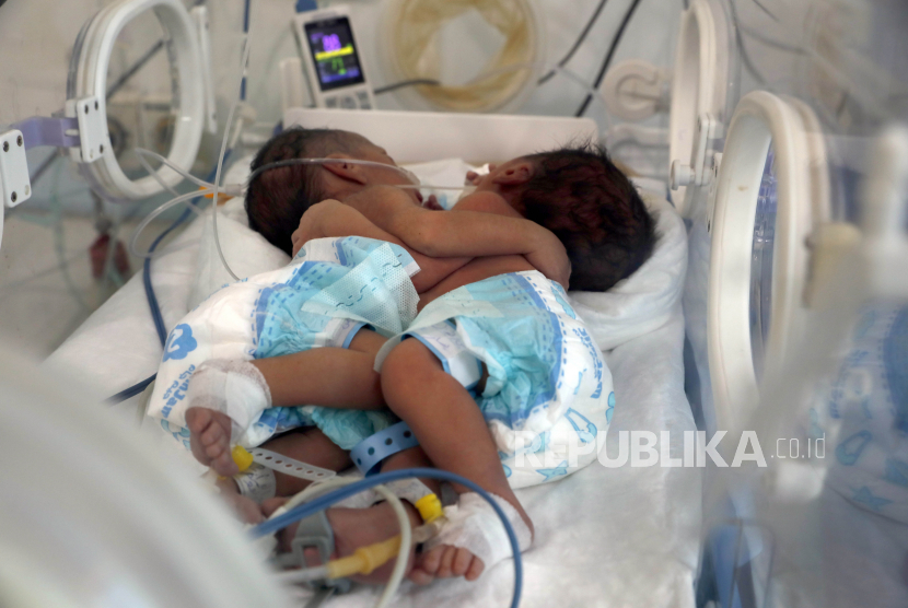  Bayi kembar siam berbaring di dalam inkubator. (Ilustrasi)