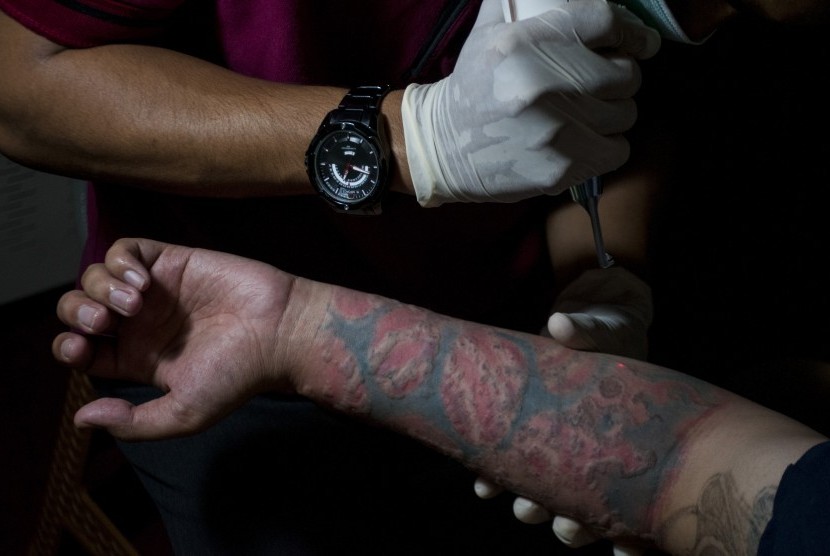 Seorang muslim menjalani proses penghapusan tato menggunakan sinar laser.
