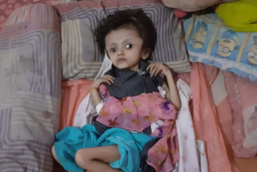 Davina (9) anak dari pasangan Yudi dan Wiwin mengidap penyakit Hidrosefalus (pembengkakan pada kepala) saat ini hanya terbaring kaku dirumahnya. 