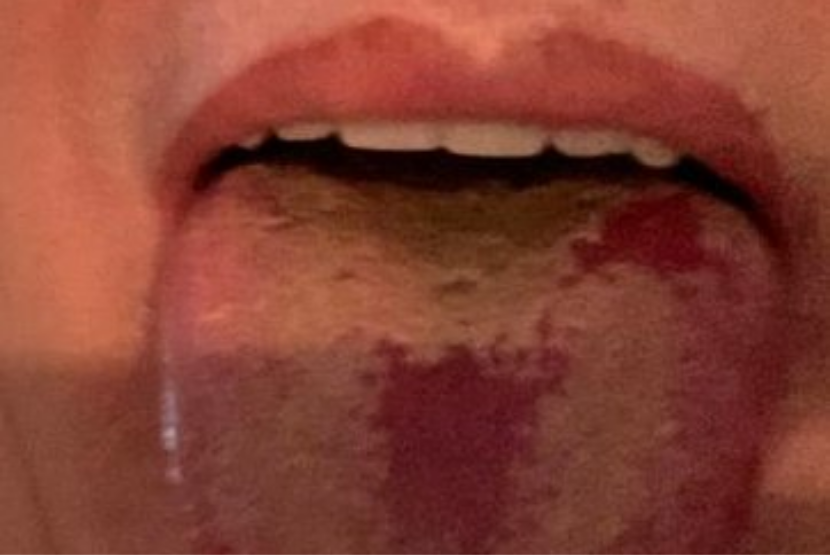 Orang yang positif Covid-19 makin banyak yang mengeluhkan gangguan pada lidahnya. Gejala penyakit yang disebabkan virus Sars Cov-2 ini kian beragam, dan covid tongue jadi salah satu gejala baru yang dijumpai di sejumlah pasien terkonfirmasi positif covid-19.