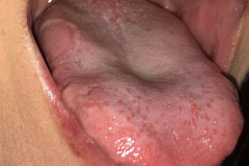 Lidah. Keluhan pada lidah dapat menjadi petunjuk adanya penyakit.