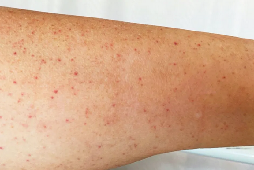 Immune thrombocytopenic purpura (ITP) mengakibatkan kulit berbintik merah, mirip ruam.