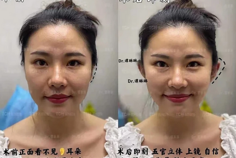 Seorang perempuan menunjukkan telinganya sebelum dan setelah menjalani operasi plastik elf ears.