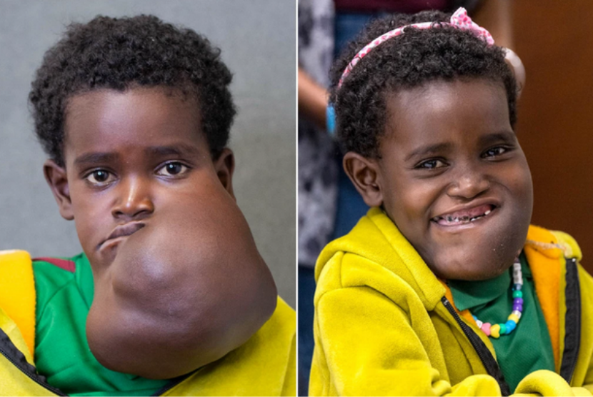 Foto kiri memperlihatkan Nagalem Alafa sebelum menjalani operasi pengangkatan tumor di wajahnya. Foto sebelah kanan memperlihatkan kondisinya setelah operasi. 
