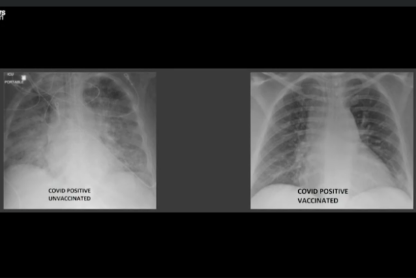 Perbandingan kondisi paru pasien Covid-19 yang belum divaksinasi dengan yang sudah divaksinasi.