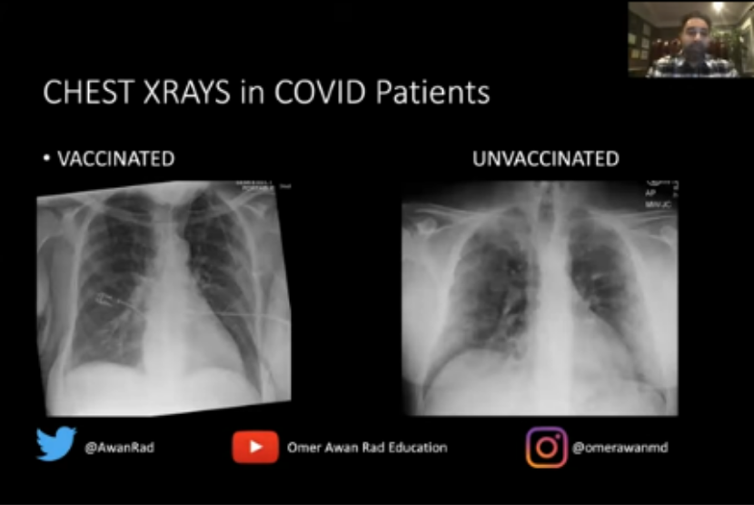 Dr Omer Awan, ahli radiologi dari University of Maryland, Amerika Serikat, memperlihatkan perbandingan hasil rontgen paru pasien Covid-19 yang divaksinasi dan tidak divaksinasi. Penyintas Covid-19 dapat merasakan gejala kerusakan paru sampai lebih dari 12 pekan setelah sembuh.