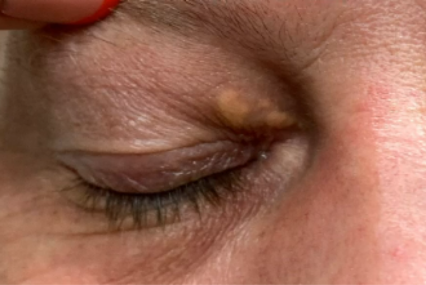 Dr Sandra Lee alias dr Pimple Popper memperlihatkan xanthelasma pada mata pasiennya. Xantelasma merupakan salah satu pertanda kolesterol tinggi. 