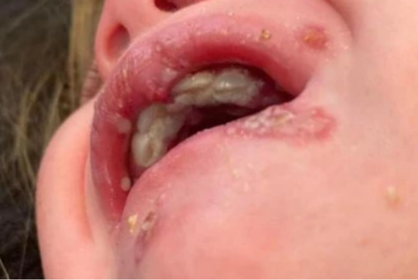 Seorang bayi mengalami cold sores setelah bibirnya dicium oleh orang dewasa pembawa virus herpes. Cold sores alias herpes labialis dapat membuat seseorang lebih berisiko mengembangkan Alzheimer.