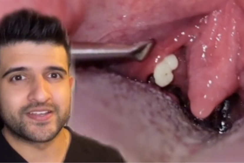 Dokter gigi Vikas Prinja memperlihatkan batu amandel penyebab bau mulut. Ia menayangkan video edukasinya melalui akun TikTok London Dentist.