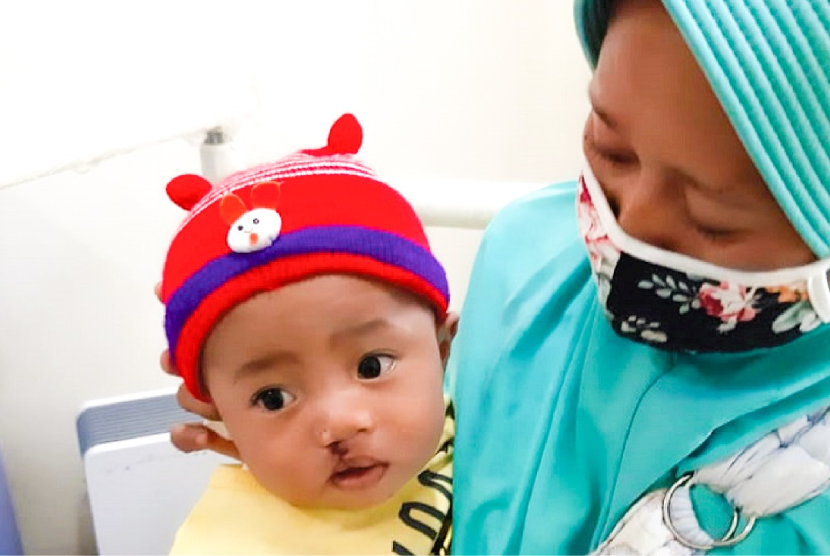 Dokter Spesialis Bedah Mulut RS Sari Asih Serang, drg Santi Anggraini SpBM (K) menyebutkan rasio kelahiran pada bayi dengan bibir sumbing adalah satu berbanding seribu.