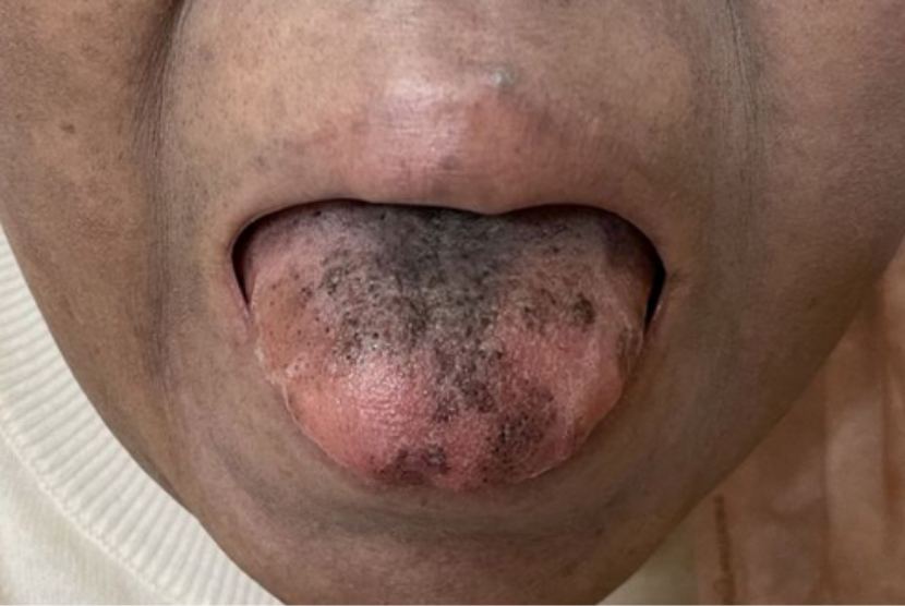 Lidah seorang perempuan di Inggris menjadi hitam dan ditumbuhi rambut setelah mengalami efek samping antibiotik. Kondisi ini disebut juga black hairy tongue.