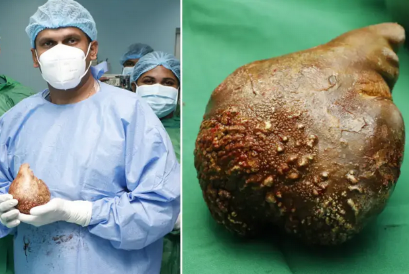Dokter memperlihatkan batu ginjal ukuran besar yang berhasil diangkat dari seorang pria di Sri Lanka.