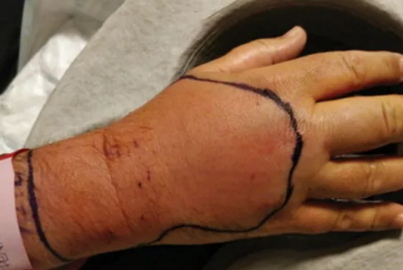 Tangan seorang pria di Inggris menjadi infeksi setelah digigit kucing liar.