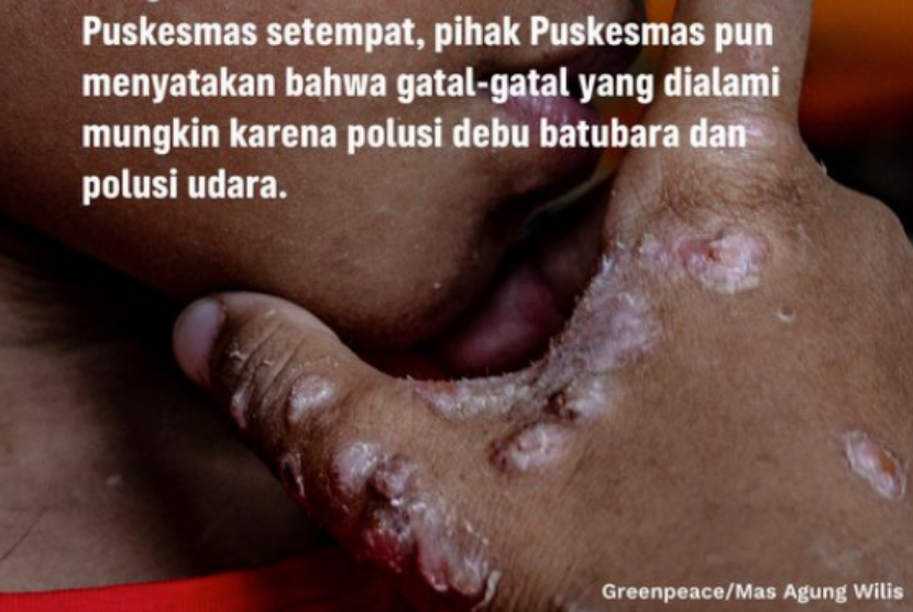 Kondisi kulit salah seorang warga Marunda, Jakarta Utara. Polusi udara dari debu batubara disinyalir menjadi penyebab penyakit kulit pada warga Marunda.