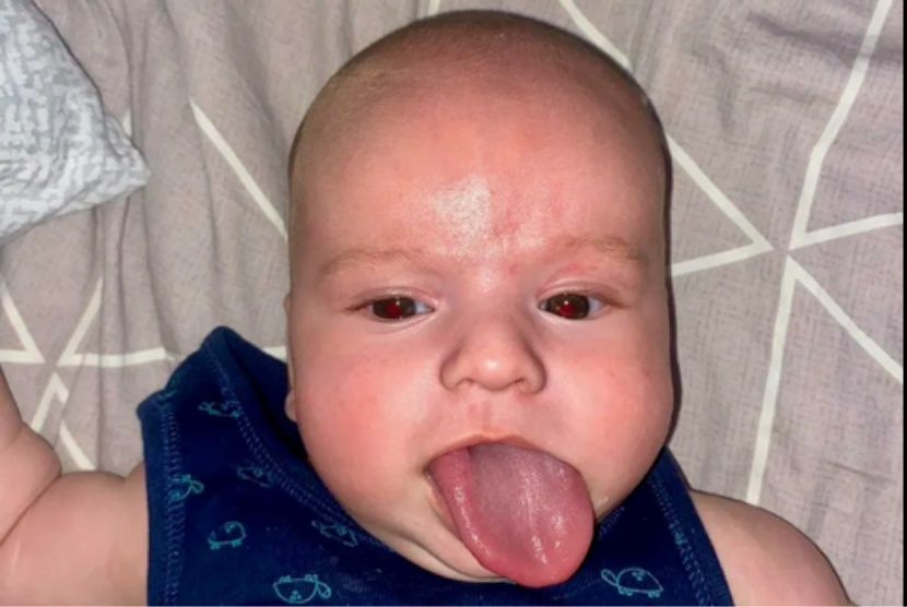 Lev, seorang bayi asal Ukraina, terlahir dengan lidah berukuran superbesar.