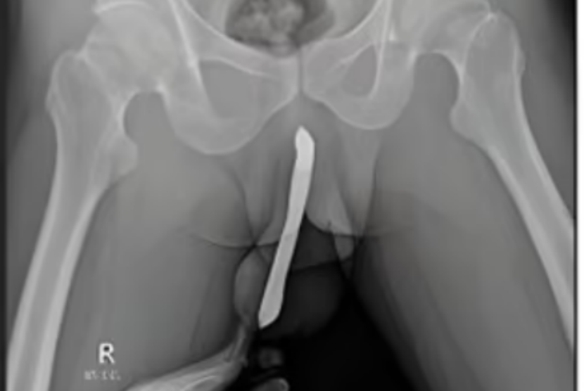 Hasil rontgen memperlihatkan sikat gigi terselip di alat vital seorang pria berusia 43 tahun asal Jawa Timur. Kasus fraktur penis yang dialaminya dilaporkan tim dokter RSUD Dr Soetomo ke International Journal of Surgery Case Reports pada 20 Februari 2024.