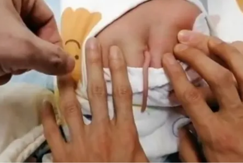 Dalam kejadian yang langka, seorang bayi yang lahir di China tampak memiliki ekor.