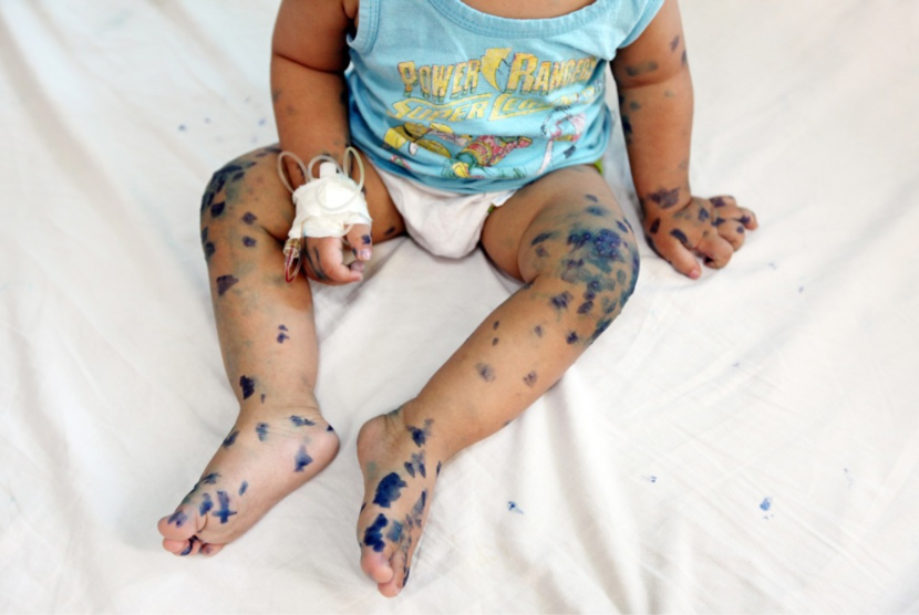 Bayi berusia satu tahun yang menderita hand, foot and mouth disease (HFMD) alias flu singapura dirawat di rumah sakit, (ilustrasi)
