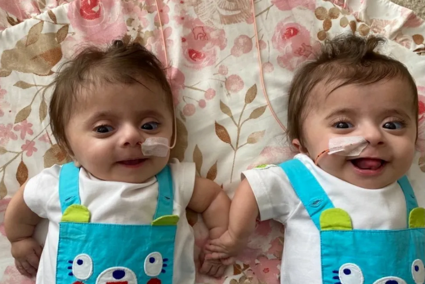 Maryam dan Mia, anak kembar yang lahir dengan osteogenesis imperfekta .
