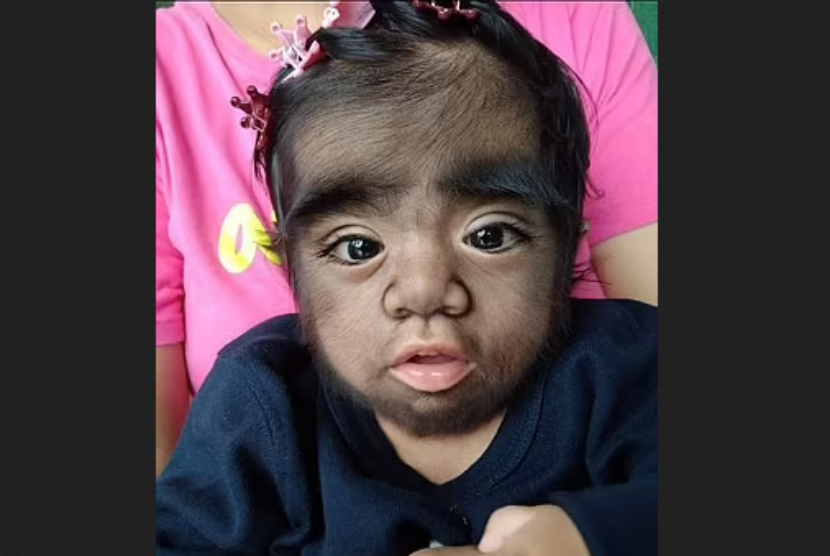 Bayi asal Filipina, Jaren Gamongan, terlahir dengan sindrom manusia serigala.