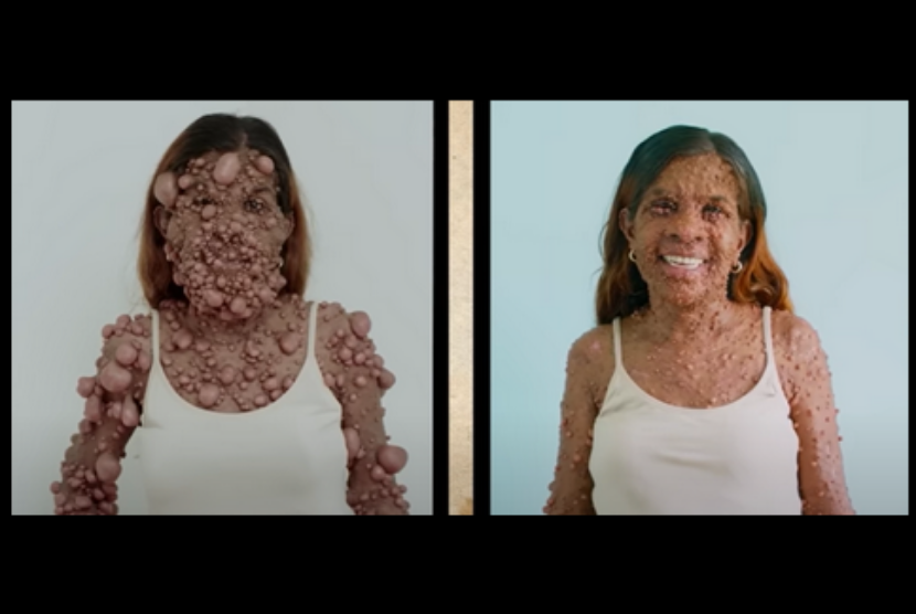 Transformasi Charmaine Sahadeo sebelum dan setelah menjalani operasi pengangkatan tumor gelembung. Wanita berusia 43 tahun asal Trinidad itu kini sudah tak kesulitan bernapas dan bisa merias wajahnya. 