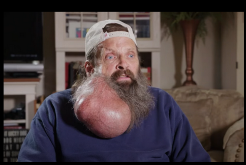 Seorang pria asal AS bernama Tim menderita adenoma pleomorfik di pipinya. Tumornya tumbuh seberat 2,2 kg setelah 16 tahun.