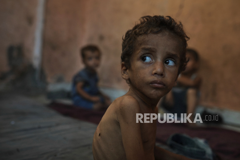 Yazan Abu Ful yang berusia 2 tahun dan kekurangan gizi, di rumahnya di kamp pengungsi Shati di Kota Gaza pada Rabu, 23 Juli 2025.