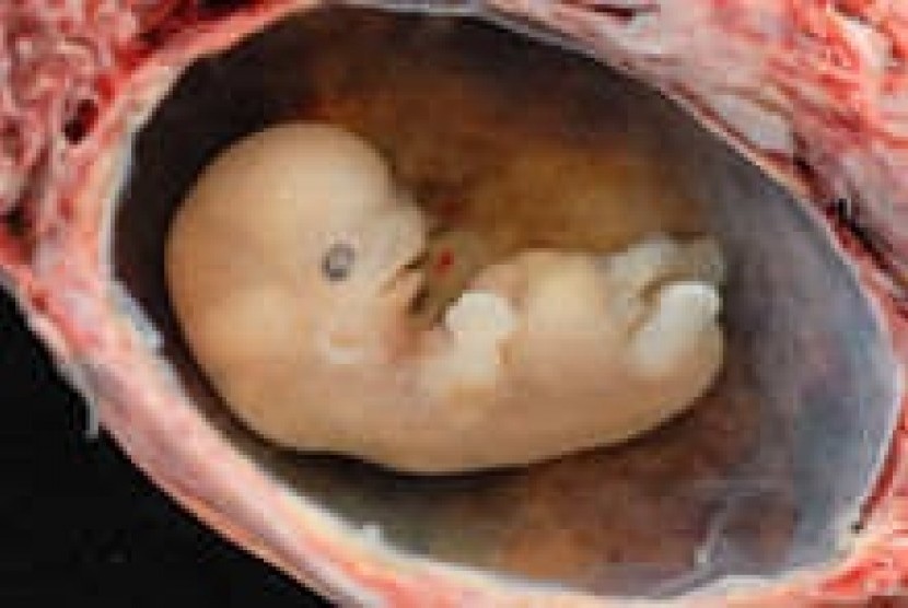 A complete spontaneous abortion at about 6 weeks from conception (illustration)