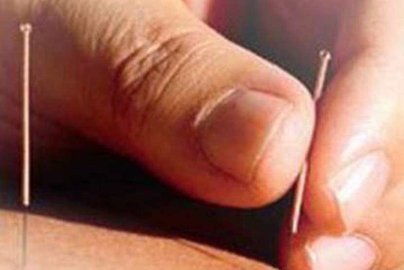 Dokter spesialis akupunktur Universitas Airlangga (Unair) Ario Imandiri mengatakan, teknik akupunktur dapat meningkatkan keberhasilan dari proses kehamilan berbantu. (ilustrasi).