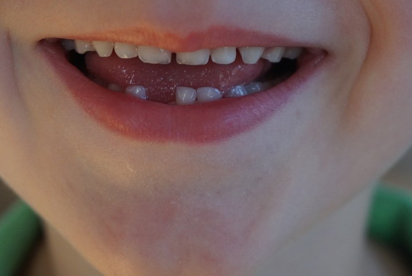 Sakit gigi bisa berdampak pada kecerdasan otak anak. (ilustrasi)