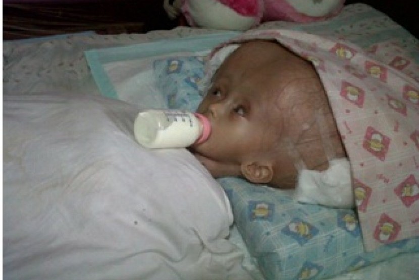 Bocah yang mengidap penyakit  hydrocephalus