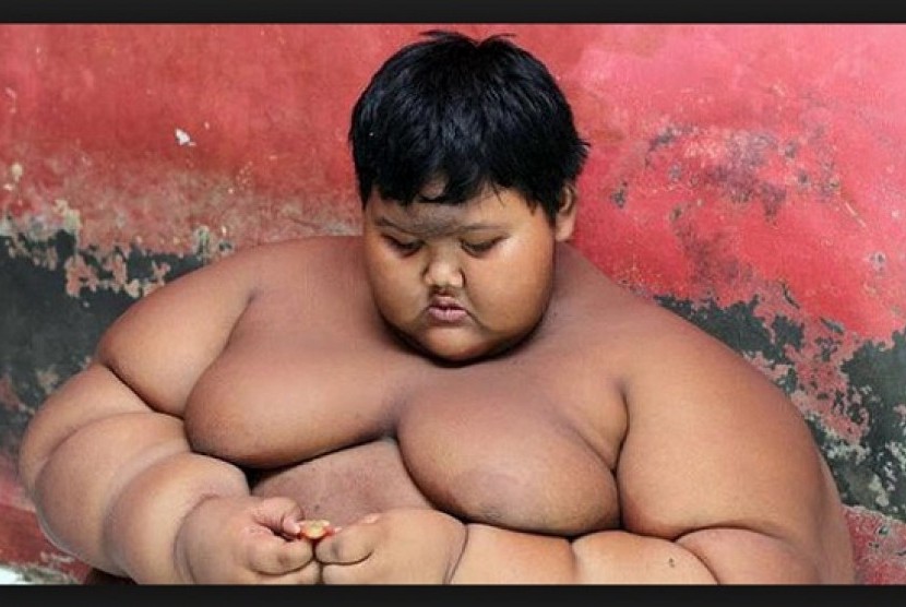 Arya Permana (10 tahun), bocah obesitas asal Karawang.