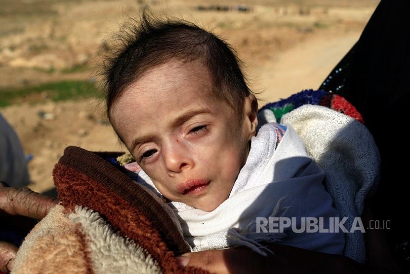 Batoul Bashir Ahmad (5bulan) bayi pengungsi Irak di Mosul yang mengalami malnutrisi menunggu truk yang akan mengangkut mereka ke tempat yang lebih aman.