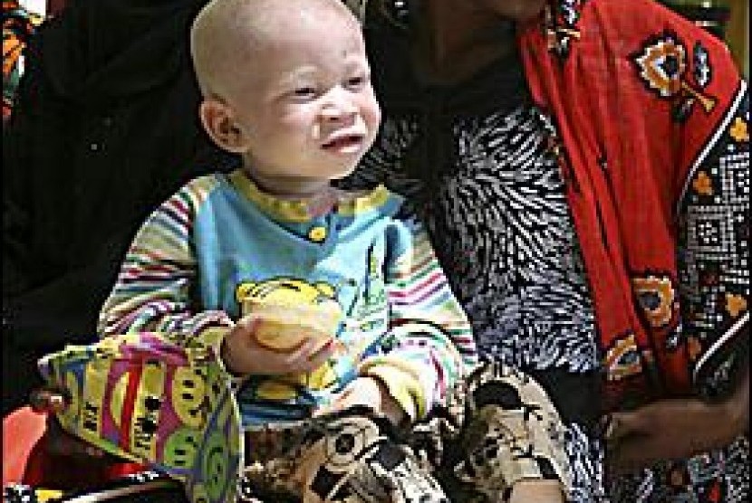 Bayi Afrika Albino