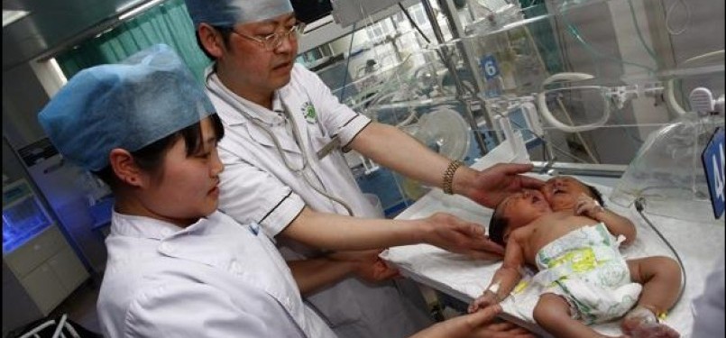 Bayi berkepala dua sedang dirawat di Rumah Sakit di Chonqqing