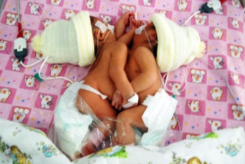 Bayi kembar siam (Ilustrasi). Operasi pemisahan bayi kembar siam Aliyah dan Aisyah akan dilakukan di RSUD Saiful Anwar, Kota Malang, Jawa Timur, Sabtu (12/8/2023).