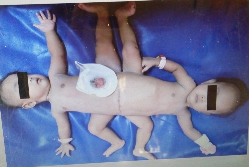 Bayi kembar siam dempet Dwi dan Tri sebelum operasi pemisahan.