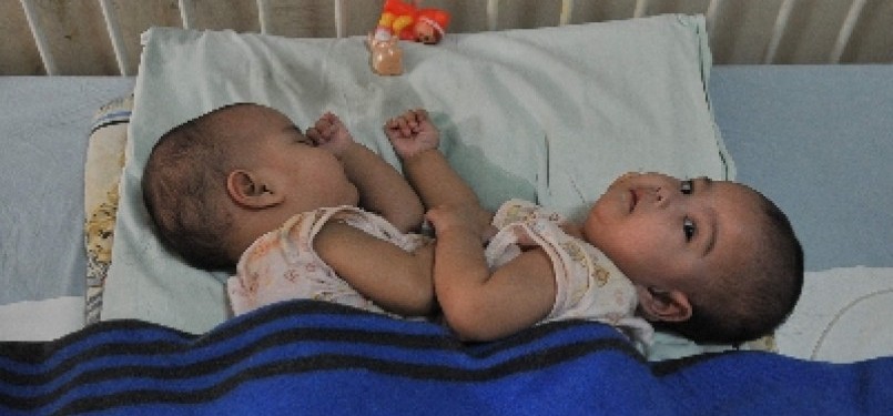 Bayi kembar Siam (ilustrasi)