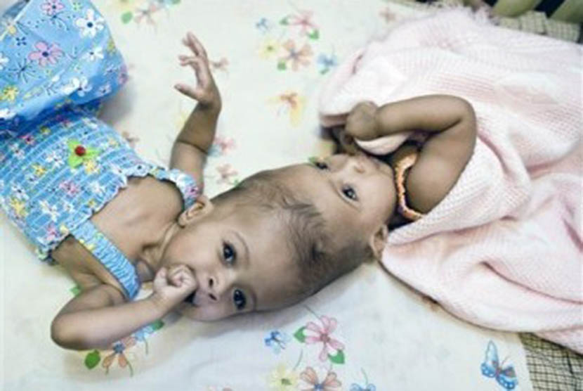 Bayi kembar Siam yang berhasil dioperasi di Rumah Sakit Anak London's Great Ormond Street, London, Inggris, Ahad (18/9).