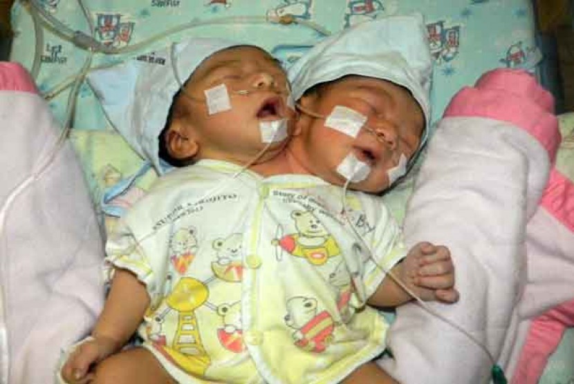  Bayi berbadan satu, berkepala dua dirawat di rumah sakit. ilustrasi