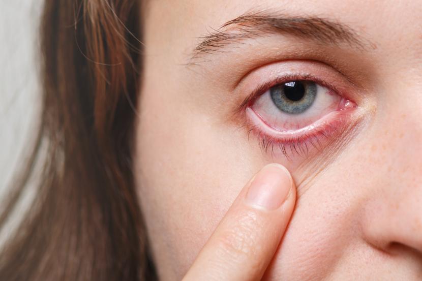 Perempuan memperlihatkan matanya (ilustrasi). Munculnya lingkaran di sekitar bagian iris mata dapat mencerminkan kadar kolesterol tinggi.