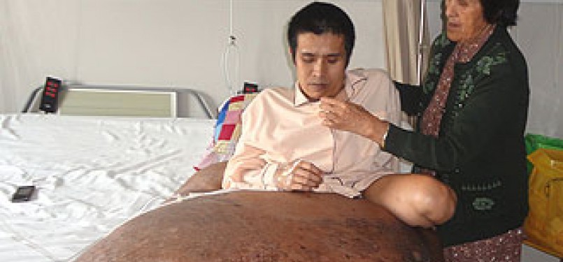 bertahun-tahun Nguyen hidup dengan tumornya