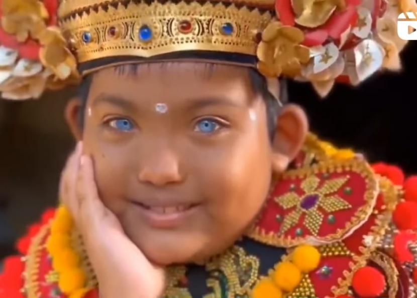 Bocah asal Buleleng, Bali, bernama Ketut Adi (9) memiliki mata biru yang langka. Dokter mata pun menjelaskan tentang kondisi tersbeut. (ilustrasi) 