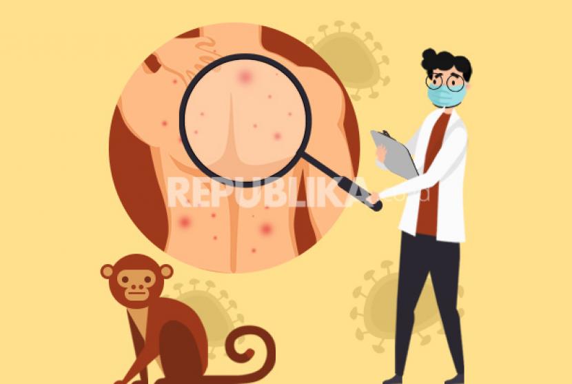 Pasien cacar monyet (ilustrasi). Menurut Dinkes DKI Jakarta, mayoritas pasien cacar monyet di Jakarta sudah terjangkit HIV.