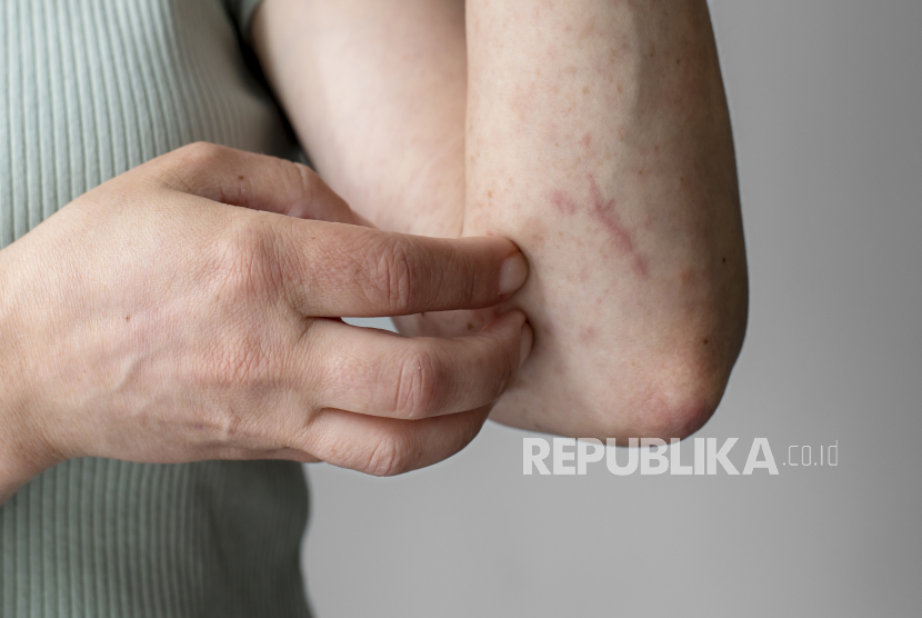 Campak (ilustrasi). 