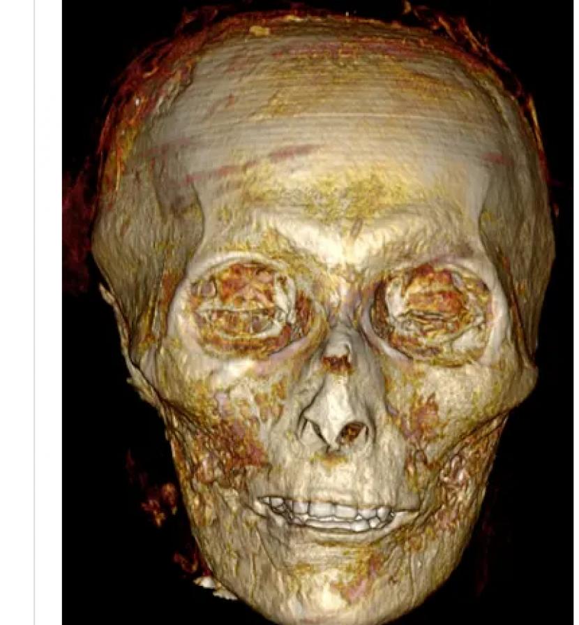 CT Scan dari mumi Amenhotep I yang memiliki susunan gigi rapi.