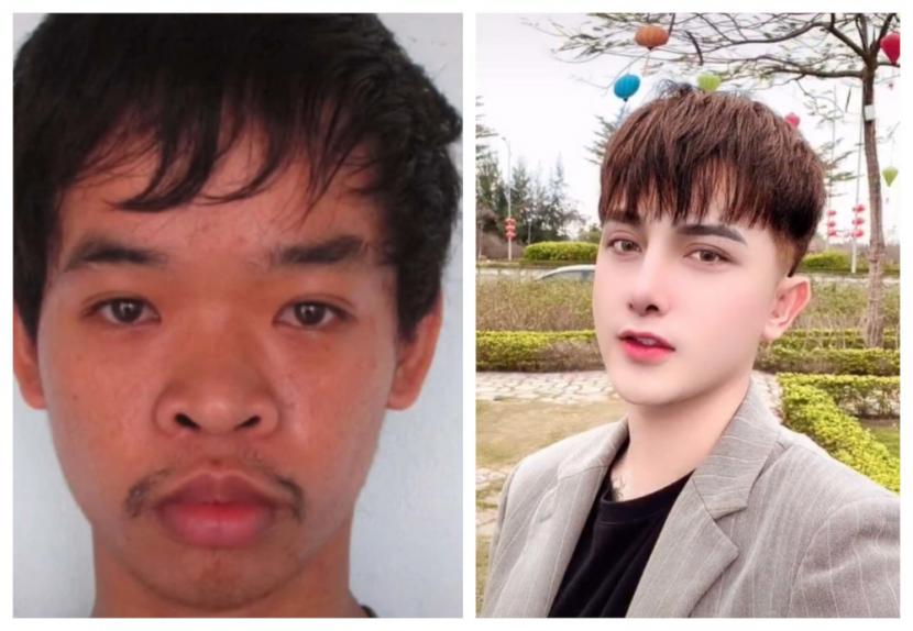 Do Quyen sebelum dan setelah menjalani operasi plastik.