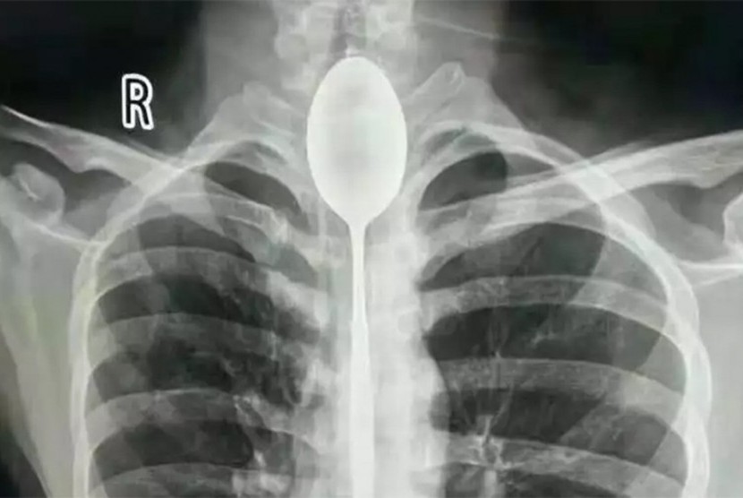 Dokter berhasil mengeluarkan sendok dari tenggorokan pria Cina setelah bersarang selama setahun.